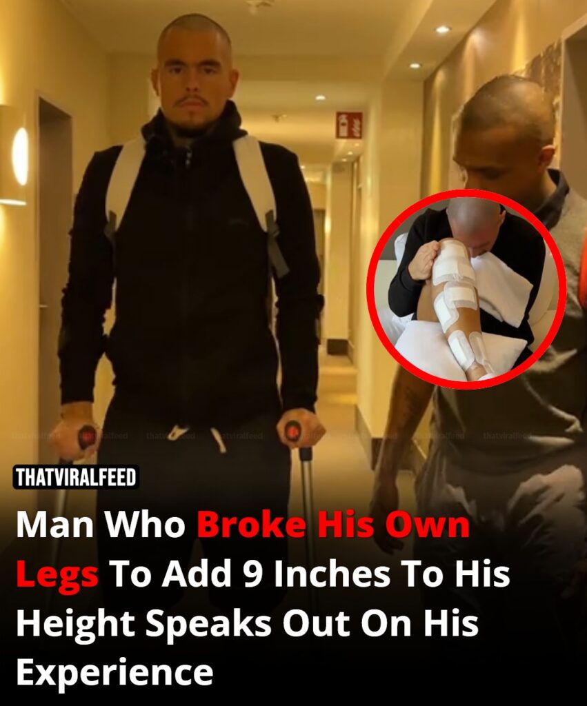 A man who broke his own legs to gain 9 inches reveals his painful transformation.