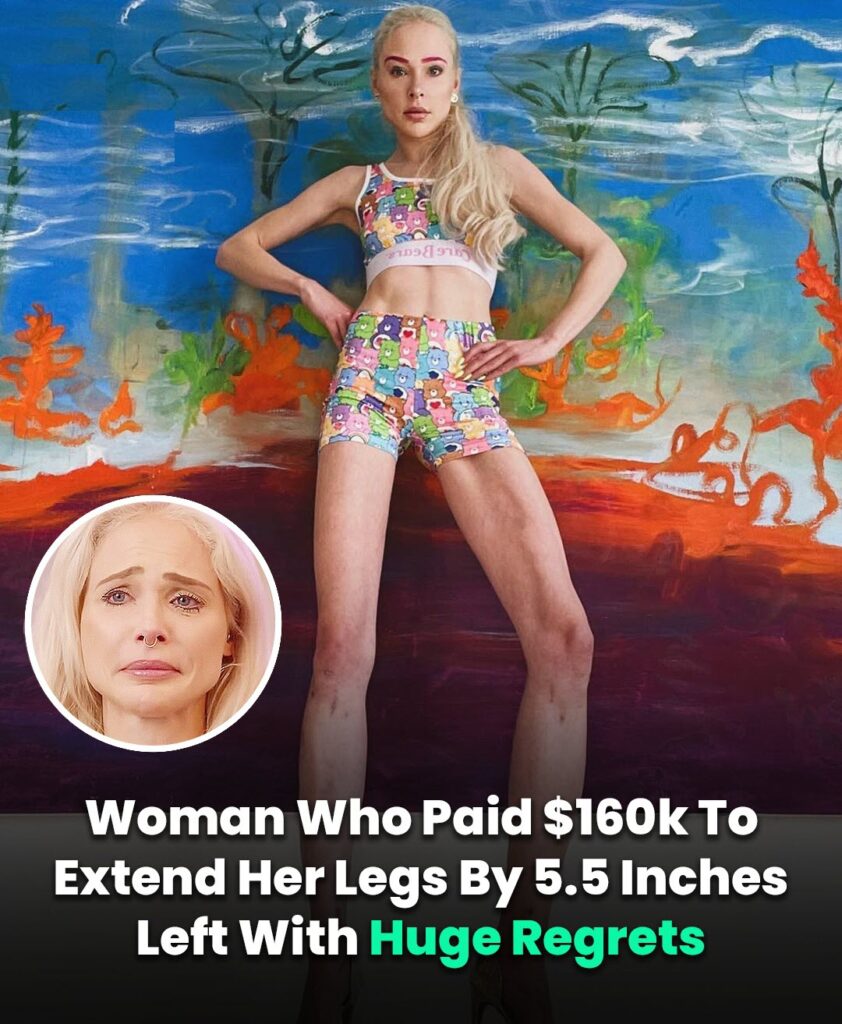 Woman Spends $161K on Leg-Lengthening Surgery – Lives to Regret It