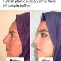 Before And After Photos From Turkish Plastic Surgery Clinic Have Left People Baffled