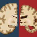 Before Dementia Sets In, Your Body Will Give You These 12 Early Warning Signs
