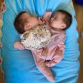 Doctors separated conjoined twins who were joined at the chest: here’s what they look like 3 years later